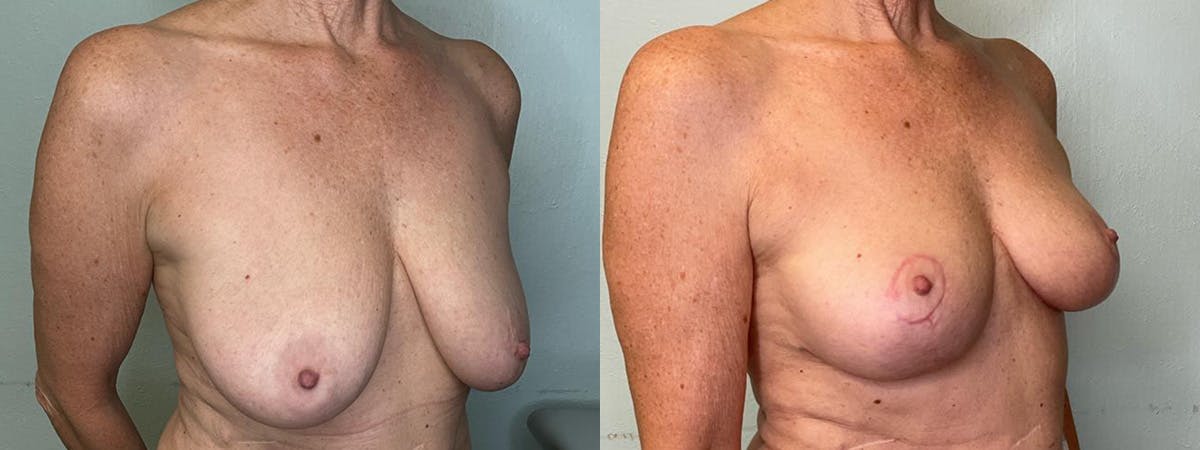 Breast Lift Before & After Gallery - Patient 361119 - Image 2