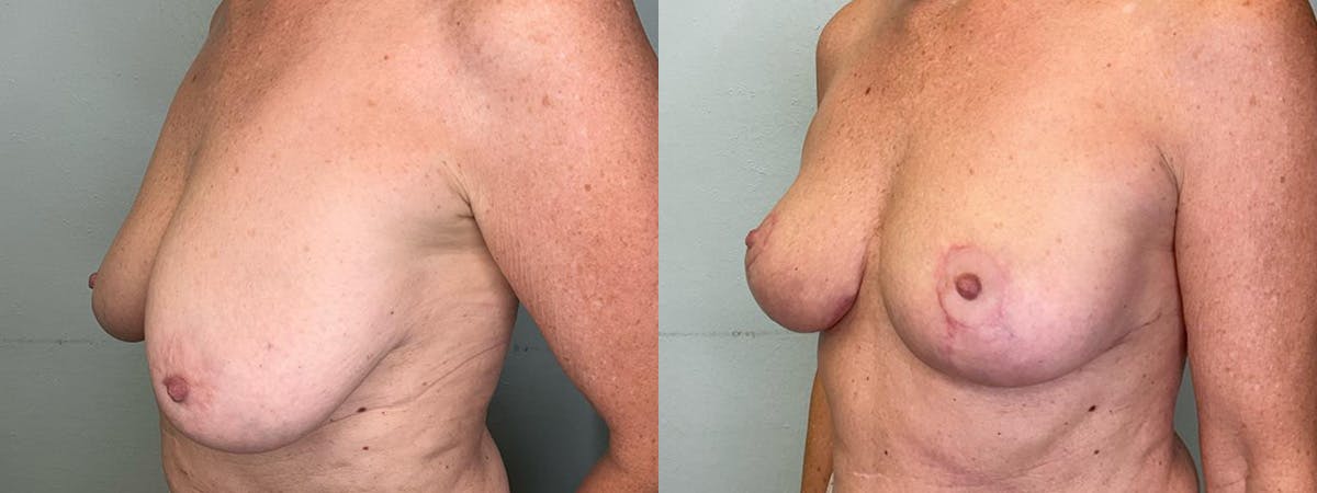 Breast Lift Before & After Gallery - Patient 361119 - Image 4