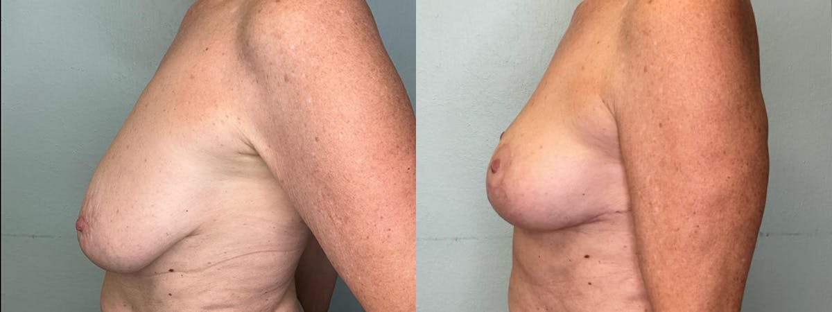Breast Lift Before & After Gallery - Patient 361119 - Image 5