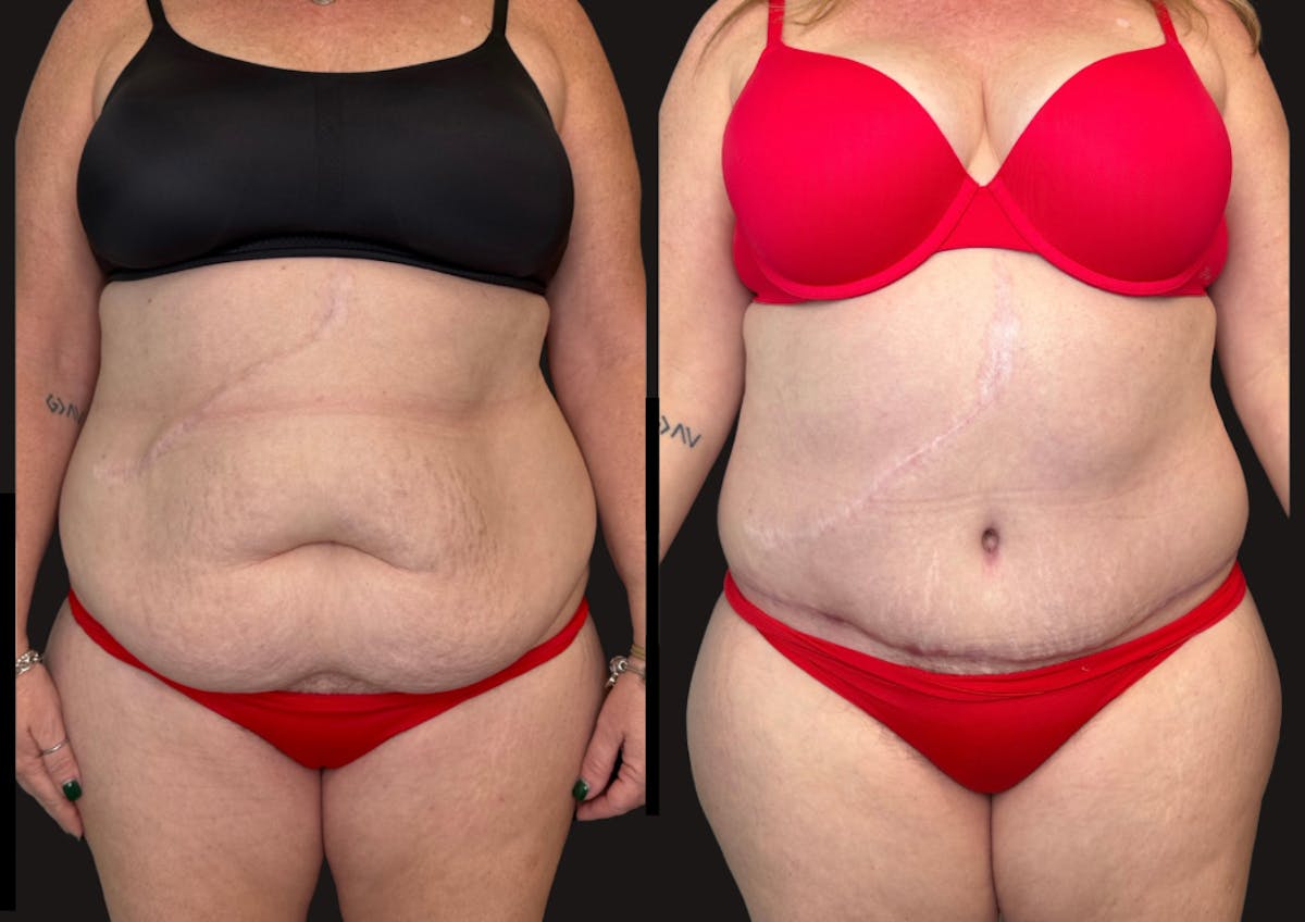 Tummy Tuck Before & After Gallery - Patient 112631 - Image 1