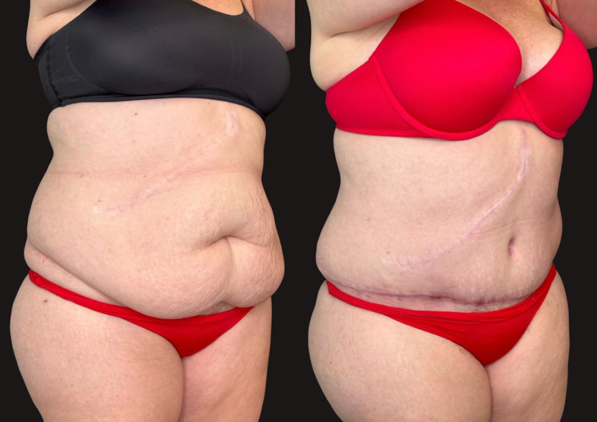 Tummy Tuck Before & After Gallery - Patient 112631 - Image 2