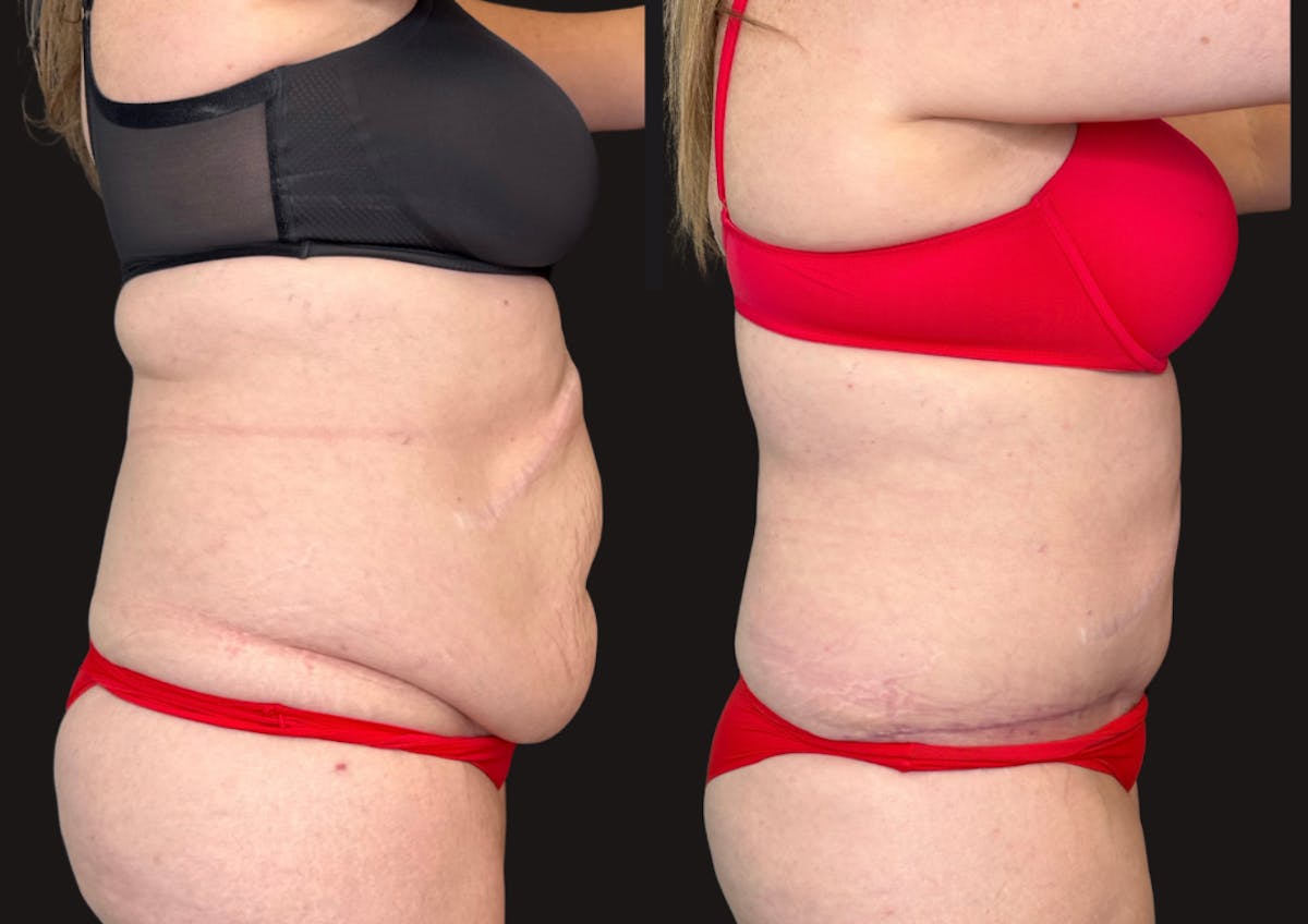 Tummy Tuck Before & After Gallery - Patient 112631 - Image 3