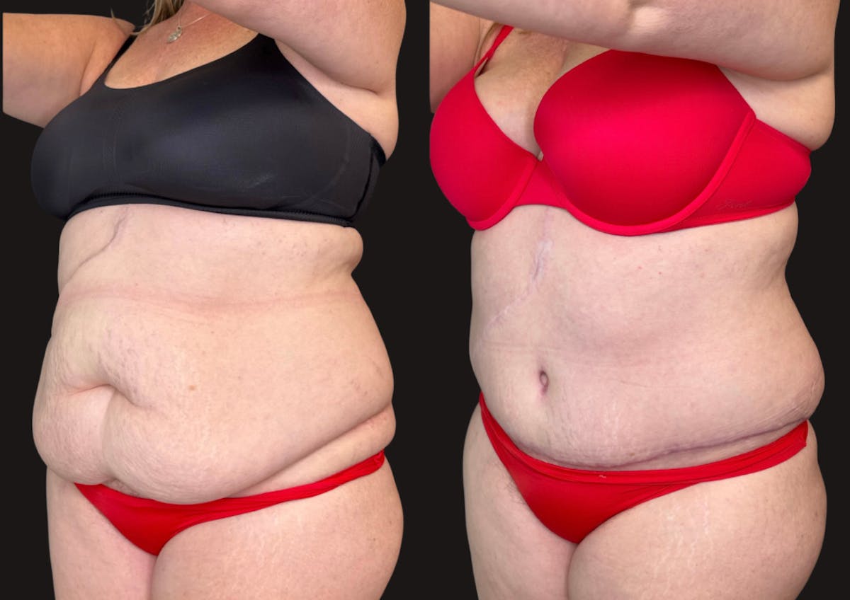 Tummy Tuck Before & After Gallery - Patient 112631 - Image 4