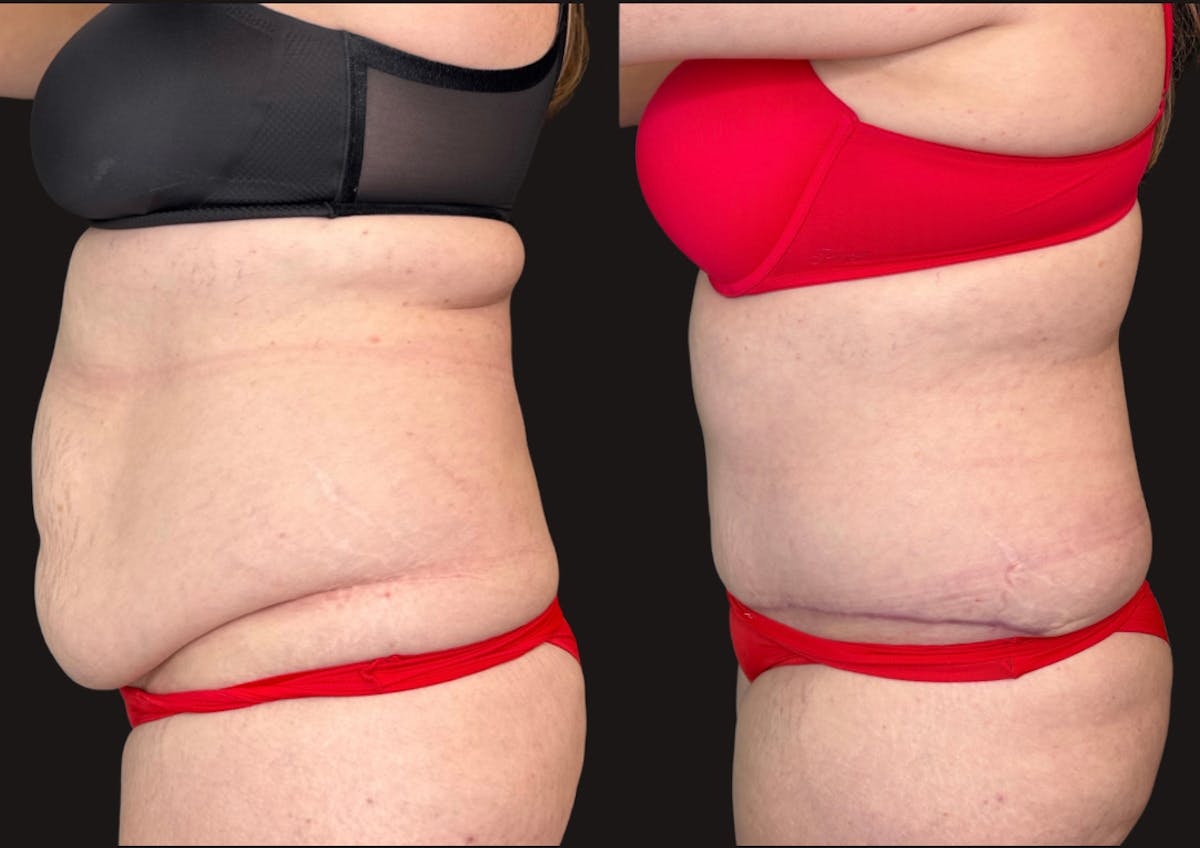 Tummy Tuck Before & After Gallery - Patient 112631 - Image 5