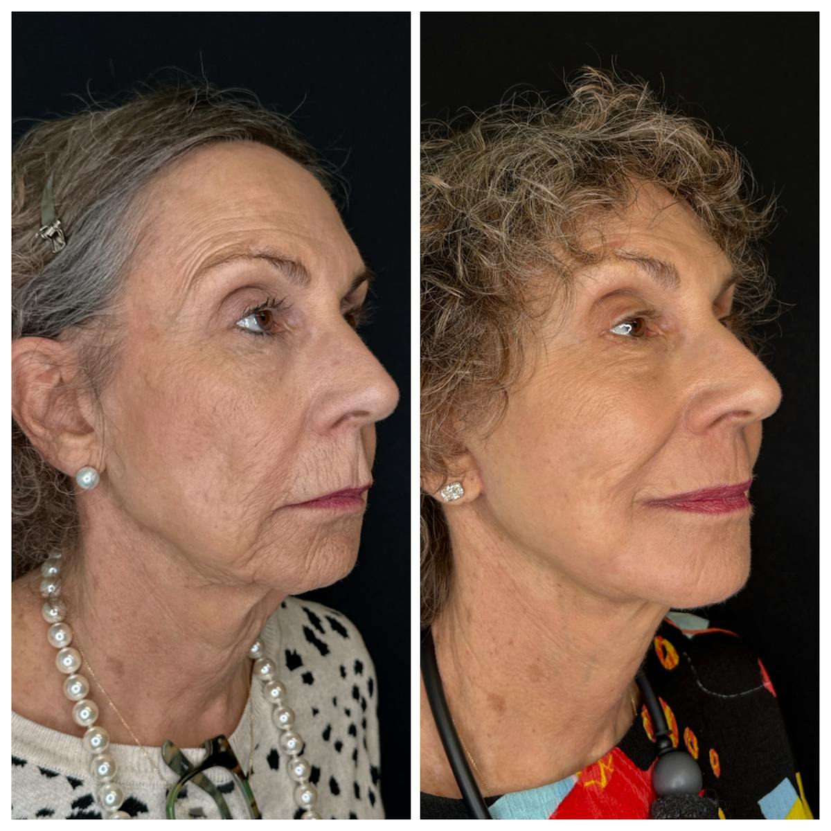 Laser Resurfacing Before & After Gallery - Patient 350362 - Image 2