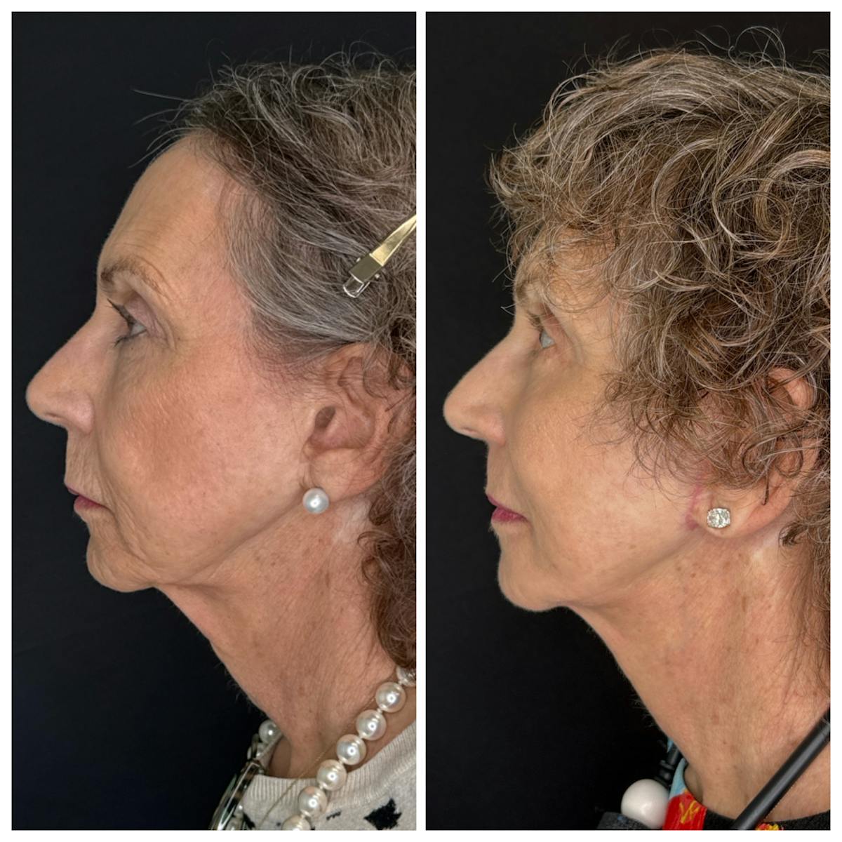 Laser Resurfacing Before & After Gallery - Patient 350362 - Image 5
