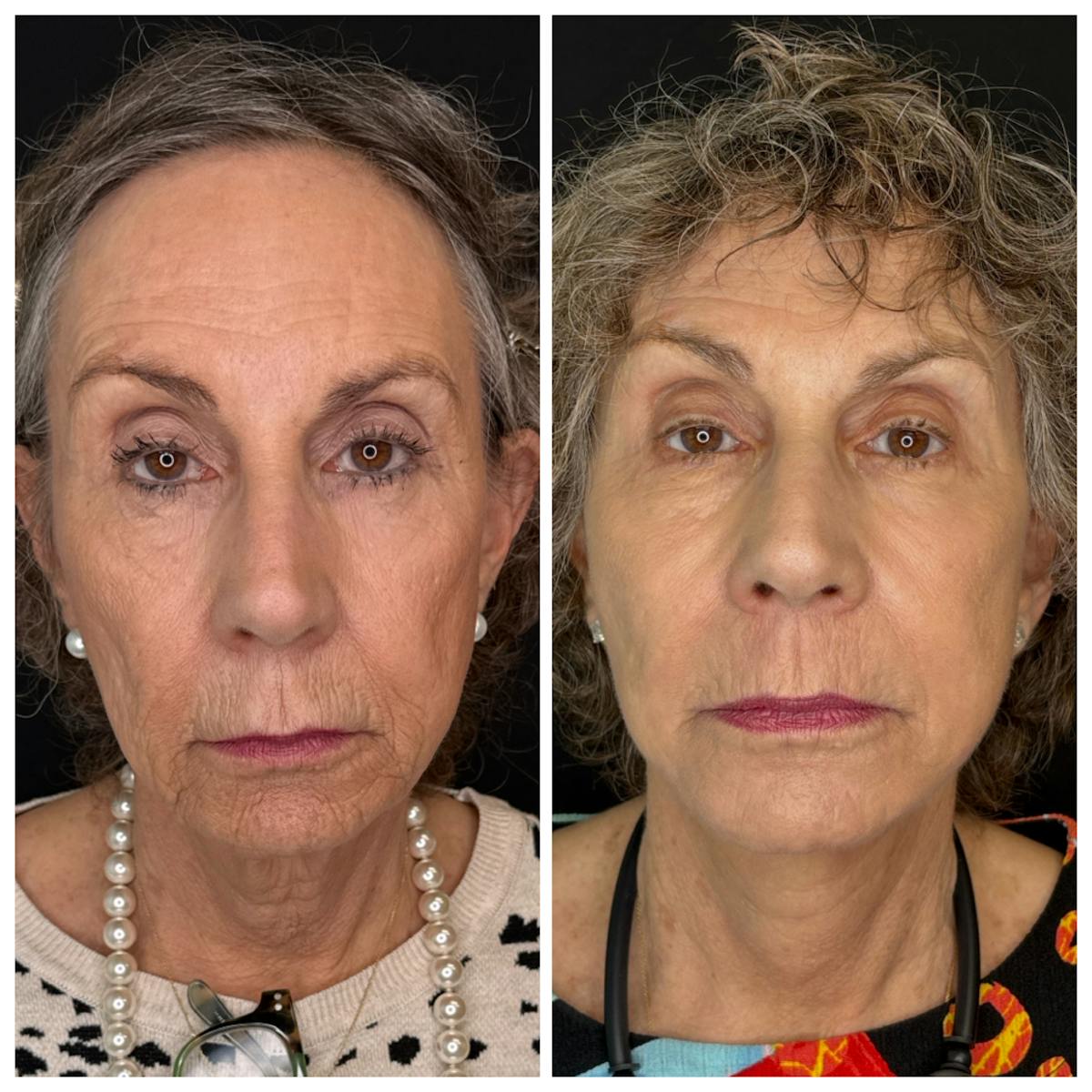Laser Resurfacing Before & After Gallery - Patient 350362 - Image 1