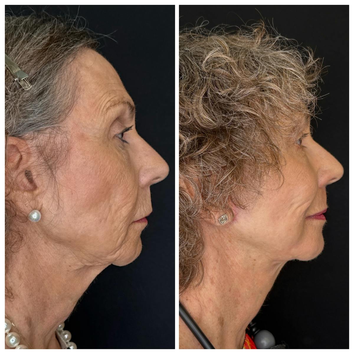 Laser Resurfacing Before & After Gallery - Patient 350362 - Image 3