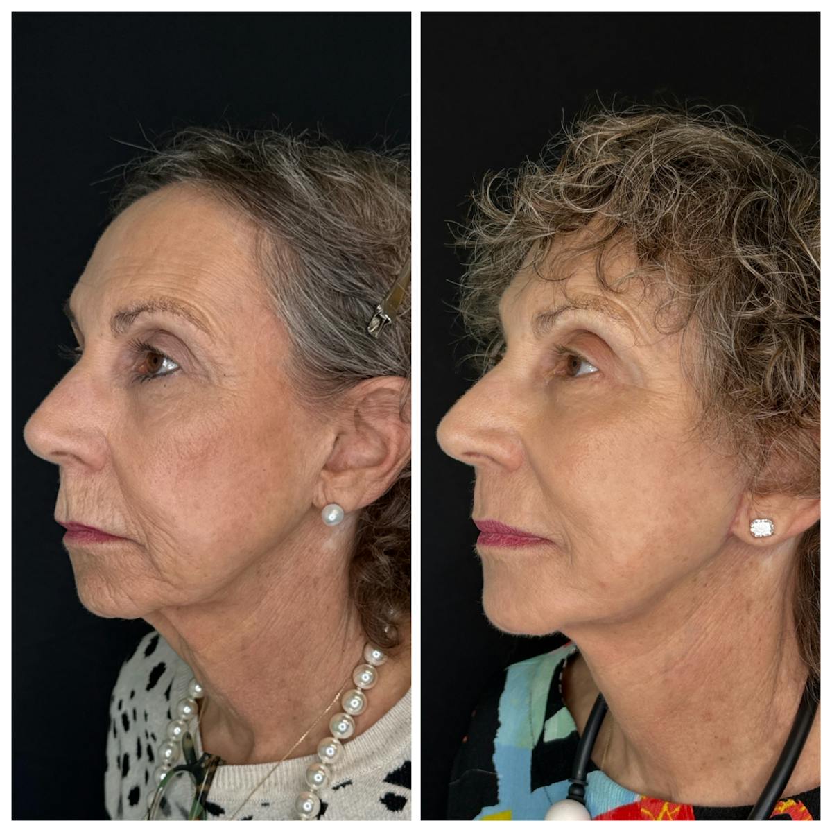 Laser Resurfacing Before & After Gallery - Patient 350362 - Image 4