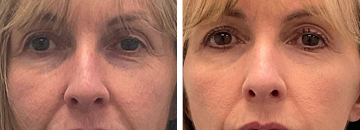 Eyelid Surgery Before & After Gallery - Patient 175827 - Image 1