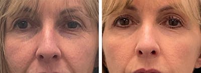 Eyelid Surgery Before & After Gallery - Patient 175827 - Image 1