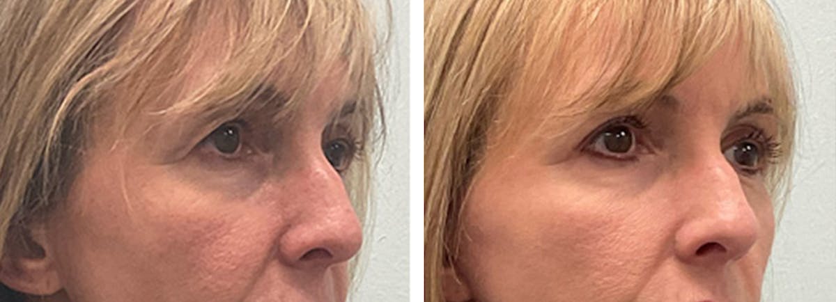 Eyelid Surgery Before & After Gallery - Patient 175827 - Image 2
