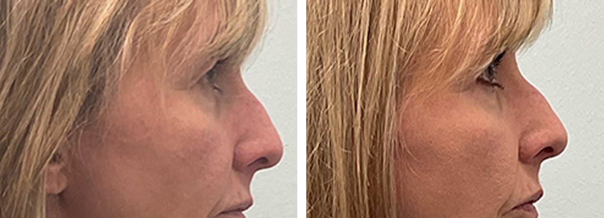 Eyelid Surgery Before & After Gallery - Patient 175827 - Image 3