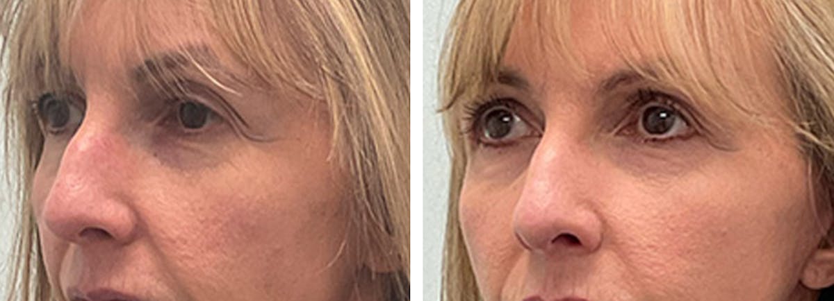 Eyelid Surgery Before & After Gallery - Patient 175827 - Image 4