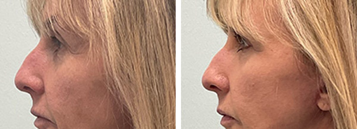 Eyelid Surgery Before & After Gallery - Patient 175827 - Image 5