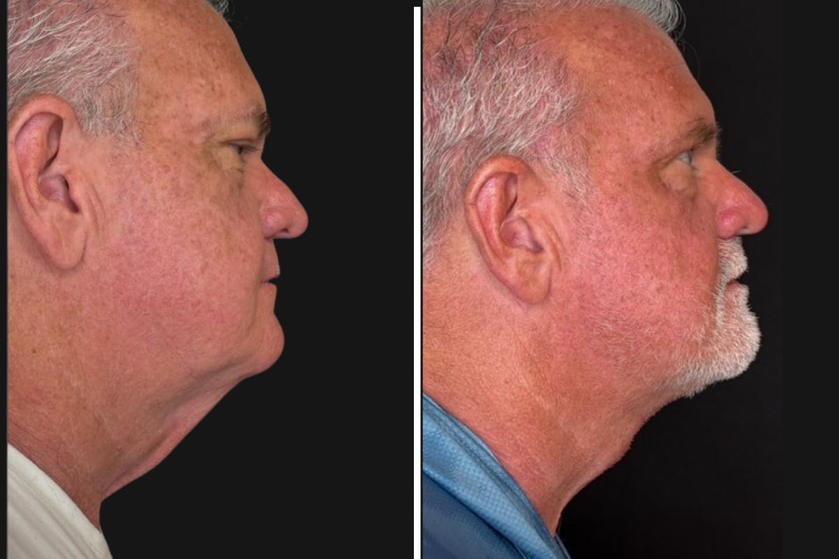Modified Neck Lift Before & After Gallery - Patient 750470 - Image 2
