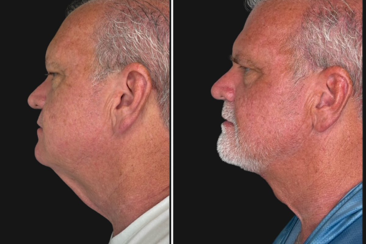 Modified Neck Lift Before & After Gallery - Patient 750470 - Image 3