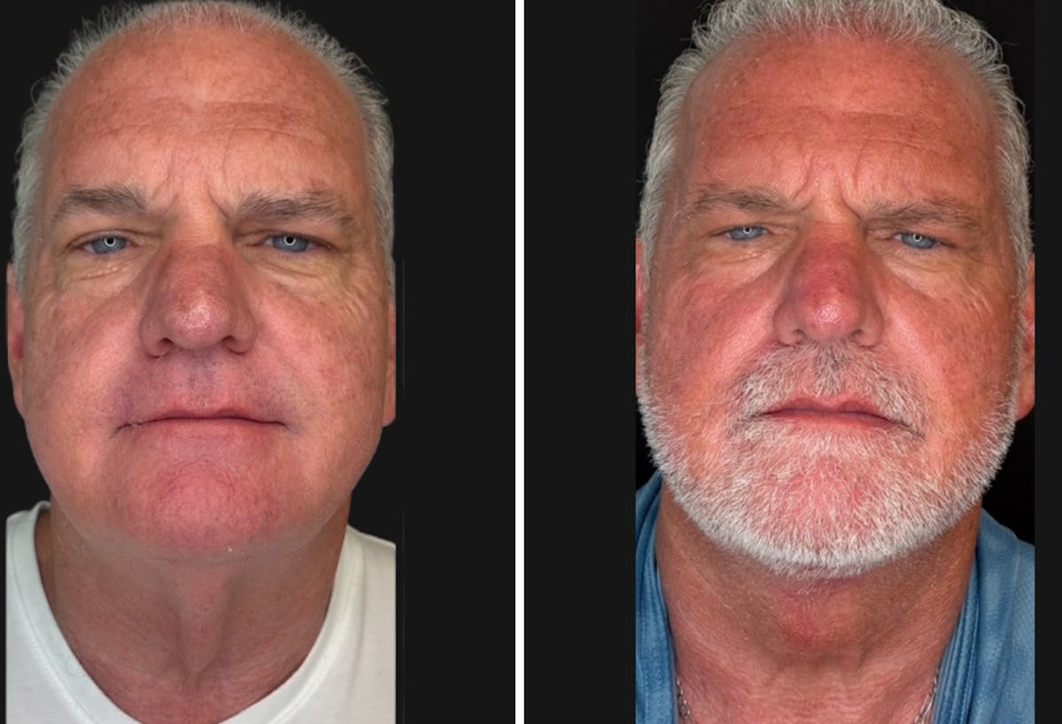 Modified Neck Lift Before & After Gallery - Patient 750470 - Image 1