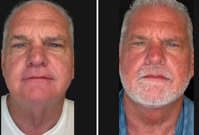 Modified Neck Lift Before & After Gallery - Patient 750470 - Image 1