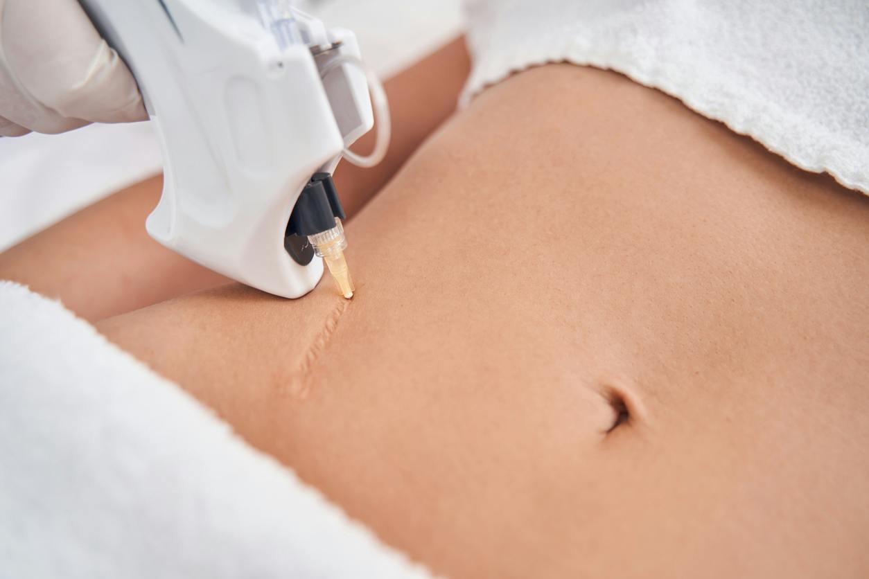Laser handpiece treating a scar on a patient's abdomen