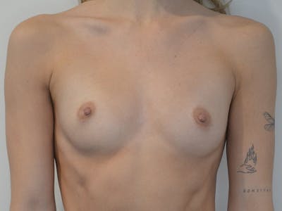 Breast Augmentation Before & After Gallery - Patient 334173 - Image 1
