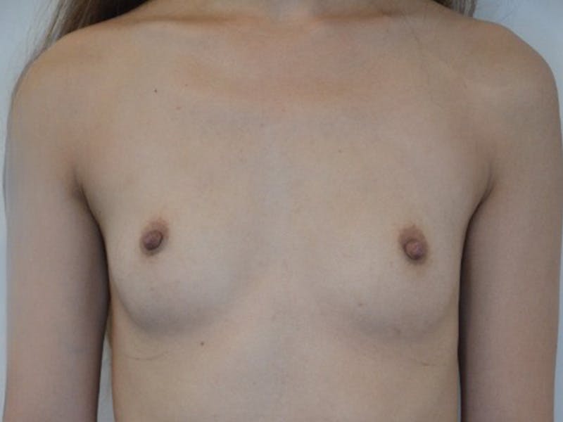 Breast Augmentation Before & After Gallery - Patient 232777 - Image 1