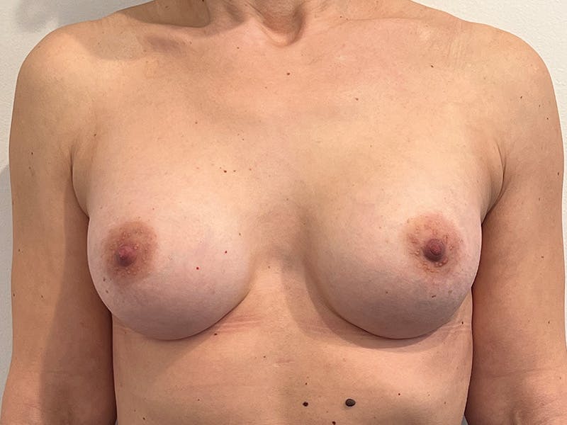 Breast Augmentation Before & After Gallery - Patient 244154 - Image 2