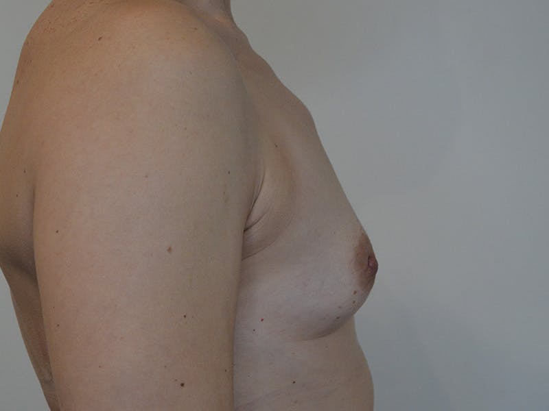 Breast Augmentation Before & After Gallery - Patient 244154 - Image 5