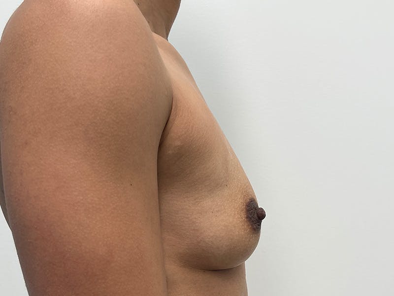Breast Augmentation Before & After Gallery - Patient 133106 - Image 5