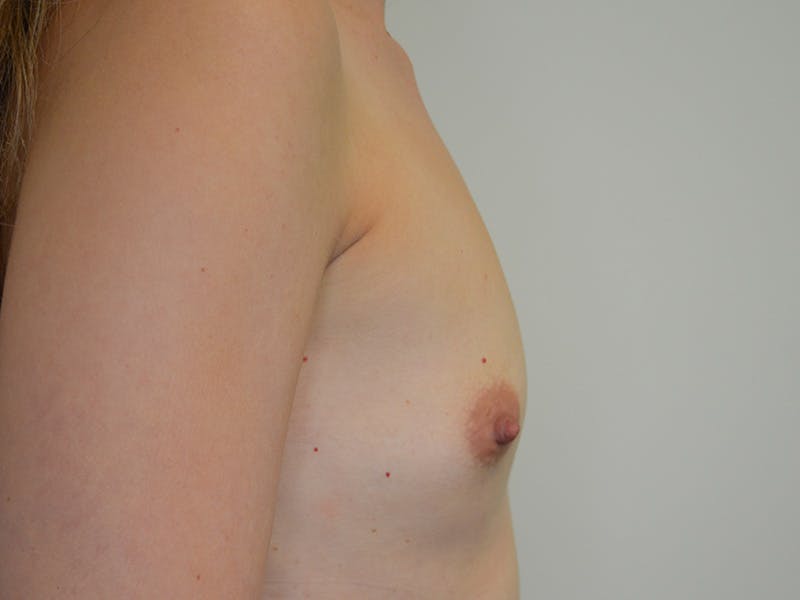 Breast Augmentation Before & After Gallery - Patient 191540 - Image 5