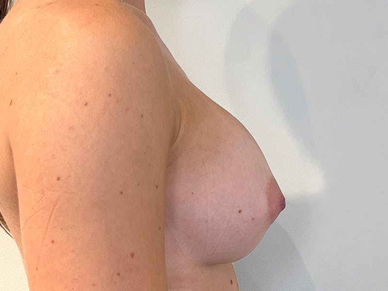 Breast Augmentation Before & After Gallery - Patient 129879 - Image 6