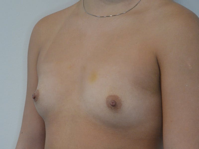 Breast Augmentation Before & After Gallery - Patient 613110 - Image 3