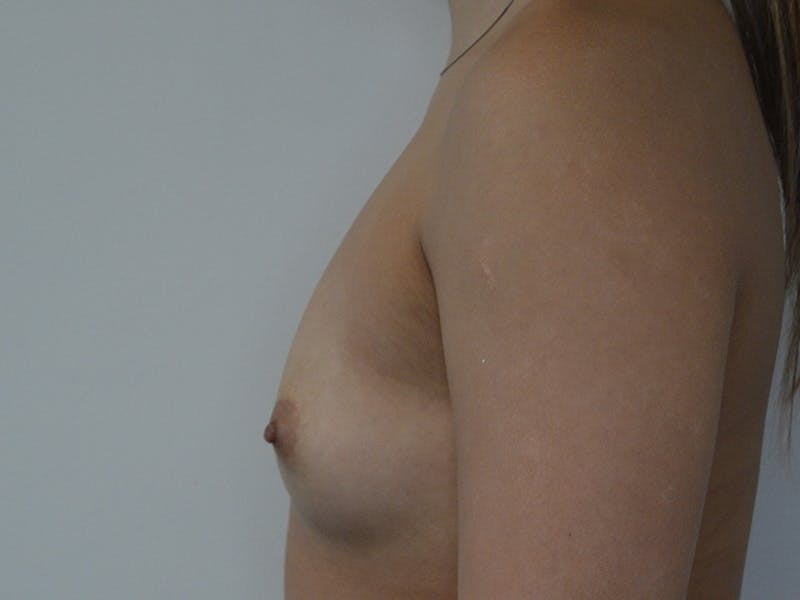 Breast Augmentation Before & After Gallery - Patient 613110 - Image 5