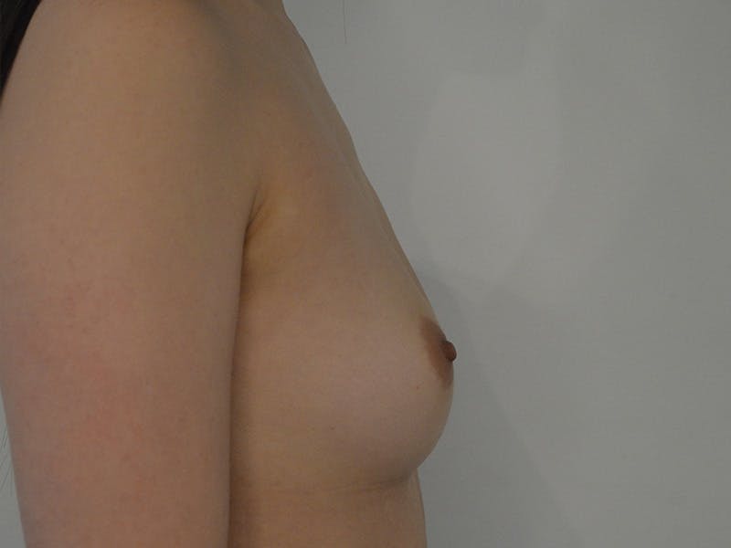 Breast Augmentation Before & After Gallery - Patient 171229 - Image 5