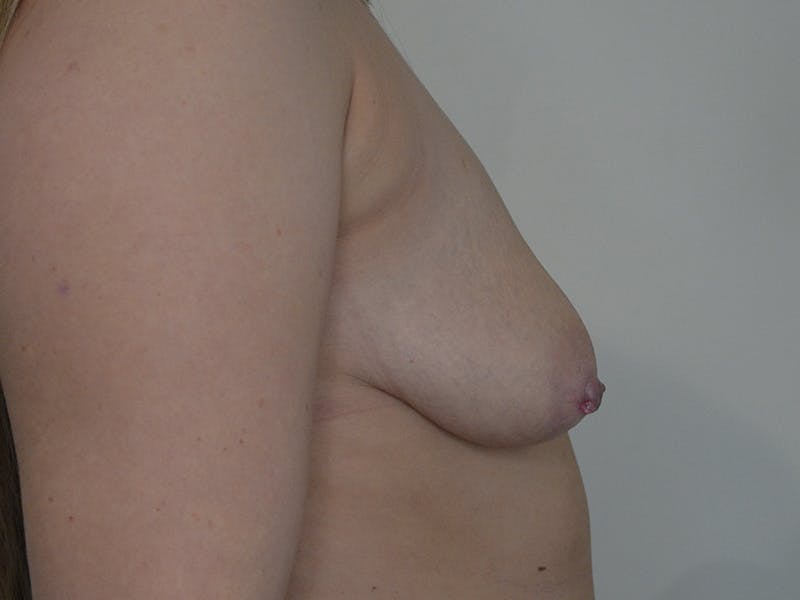 Breast Augmentation and Lift Before & After Gallery - Patient 252005 - Image 5