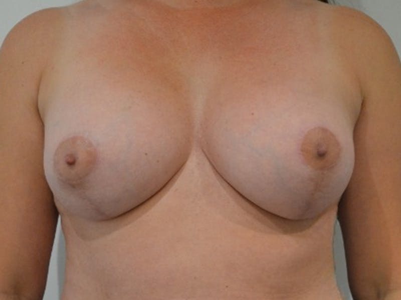 Breast Augmentation and Lift Before & After Gallery - Patient 899930 - Image 2