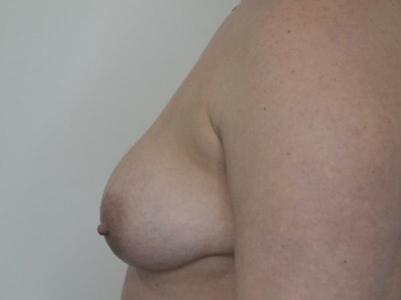 Breast Augmentation and Lift Before & After Gallery - Patient 899930 - Image 5