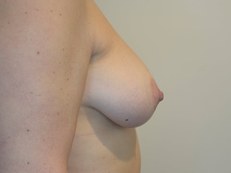 Breast Augmentation and Lift Before & After Gallery - Patient 169972 - Image 5