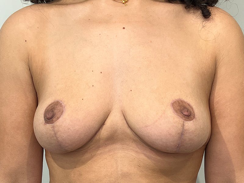 Breast Lift Before & After Gallery - Patient 344353 - Image 2