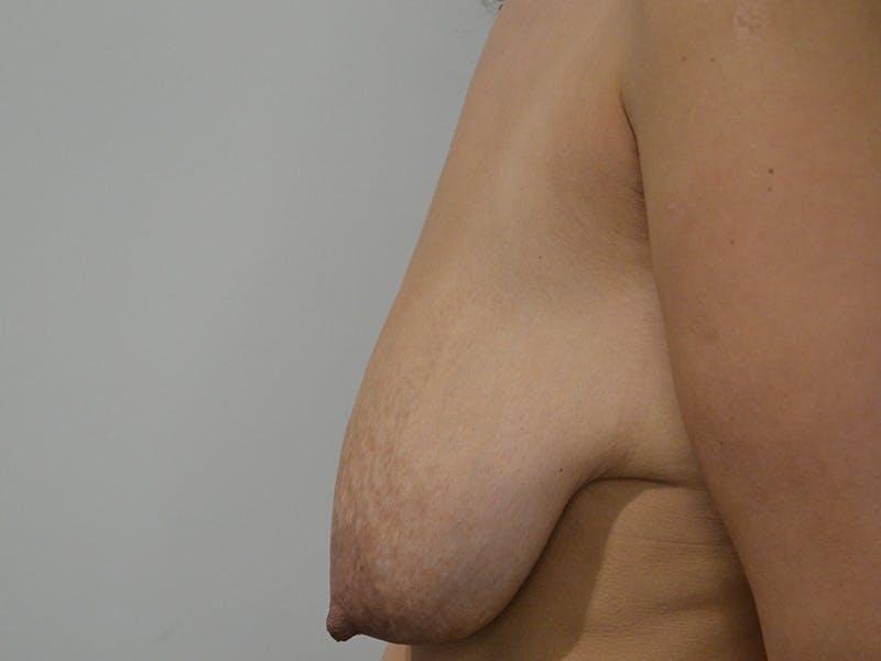 Breast Lift Before & After Gallery - Patient 344353 - Image 5