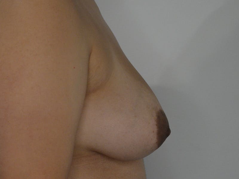 Breast Lift Before & After Gallery - Patient 912654 - Image 5