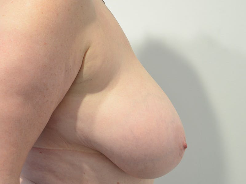 Breast Lift Before & After Gallery - Patient 579584 - Image 5