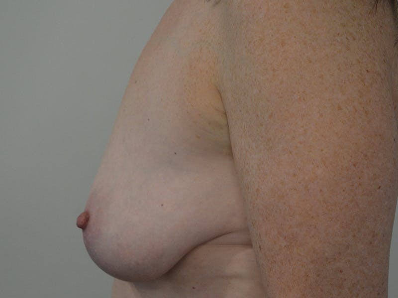 Breast Lift Before & After Gallery - Patient 427492 - Image 5