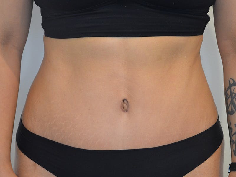 Tummy Tuck Before & After Gallery - Patient 134100 - Image 2