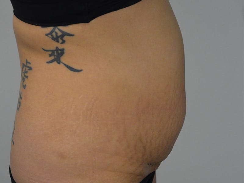 Tummy Tuck Before & After Gallery - Patient 134100 - Image 5