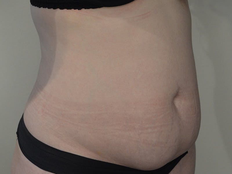 Tummy Tuck Before & After Gallery - Patient 329306 - Image 3