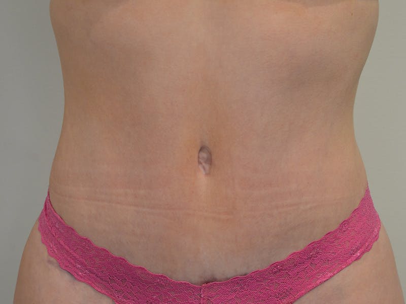Tummy Tuck Before & After Gallery - Patient 329306 - Image 2