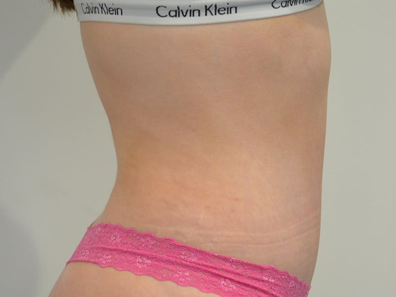 Tummy Tuck Before & After Gallery - Patient 329306 - Image 6