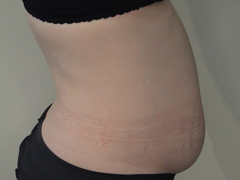 Tummy Tuck Before & After Gallery - Patient 329306 - Image 5