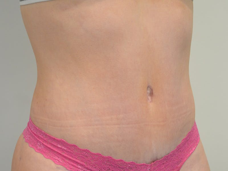 Tummy Tuck Before & After Gallery - Patient 329306 - Image 4